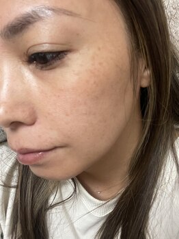 ニンテ(nintte)/【ビフォー写真 撮影】