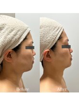 エレーナ(ELENA)/BBLフェイシャル