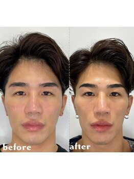 メンズフェイシャル