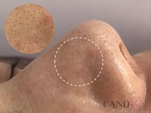 キャンディ 名古屋金山店(CANDi)/ハイドラピーリング黒ずみ毛穴◎