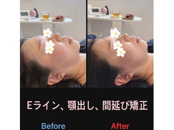 美容矯正サロン レレポノ(LELEPONO)/Eライン
