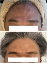 アマリージョヒラソル/Lit ヒト幹細胞エステ