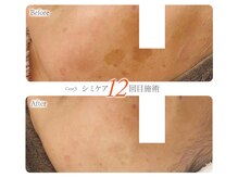 シミケア専門店O.B.M 博多阪急店/シミケア