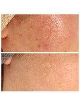 エリン(ERIN)/水光ピール