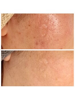 エリン(ERIN)/水光ピール