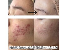 エメ(Aimer)の雰囲気（毛穴黒ずみ/皮脂つまり/開きなどのトラブル当店にお任せください）