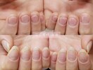深爪矯正before&after