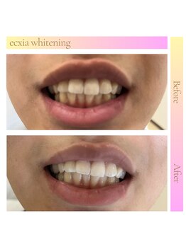 エクシアホワイトニング 三宮駅前店/ホワイトニングビフォーアフター