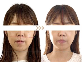 メラリノ(Melalino)/シンメトリー小顔×内臓整美SET