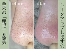 ティーツリー 名古屋 桜山(Tea Tree)/毛穴エクストラクションで陶器肌