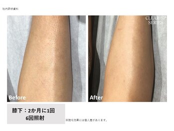 フェムーン(FEMOON)/夏前必須！美肌にも◎全脚脱毛