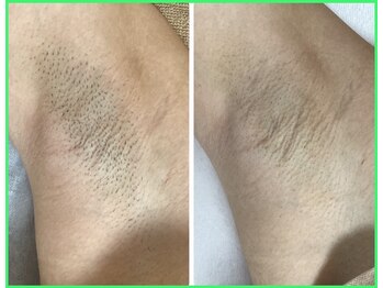 クリア 尾張旭店(Clear)/【Clear脱毛ビフォーアフター】