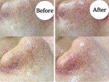 ゆらり/毛穴詰りケア