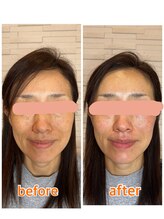 ミルーネ(milune)/フェイシャルbefore after