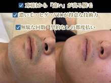 ダイヤ 名古屋中川区店(Daiya)/黒さ、青みの強いヒゲ