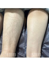 カナウ(KANAU)/脚脱毛（20代前半男性）