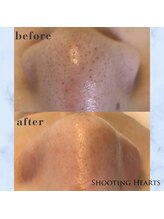 シューティングハーツ(SHOOTING HEARTS)/大人気★毛穴洗浄
