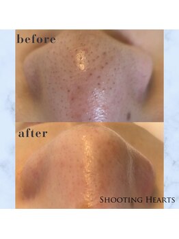 シューティングハーツ(SHOOTING HEARTS)/大人気★毛穴洗浄