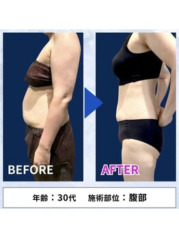 レアレア(Lea l'ea)の写真/60分で結果が見える！最新脂肪冷却マシンで気になるたるみを改善し、太ももの隙間もGET☆