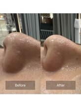 ケアナ 梅田店(CareNa)/ツヤ肌毛穴洗浄★ヒト由来幹細胞