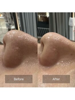 ケアナ 梅田店(CareNa)/ツヤ肌毛穴洗浄★ヒト由来幹細胞