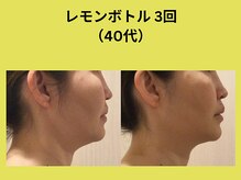 アユアランリンク 札幌店/レモンボトル/40代/3回