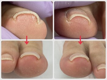 爪処 中野坂上/巻き爪ケア