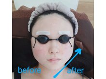 プチサロンリル(petit salon Lilou)/一瞬で小顔に！光フェイシャル