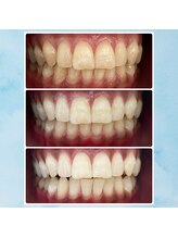 エンコロレ(encolore)/《クリスタルホワイトニング》