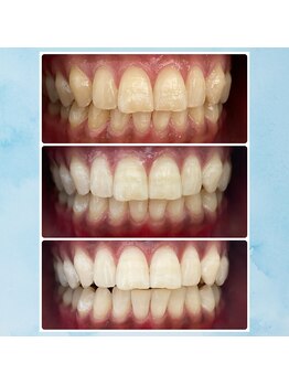 エンコロレ(encolore)/《クリスタルホワイトニング》