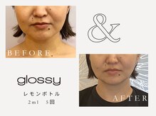 グロッシー(glossy)/【症例】レモンボトル口横ポニョ