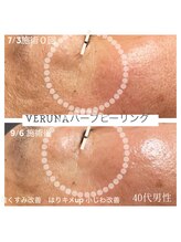 ココ 2号店(CoCo)/ハーブピーリング/肌質改善