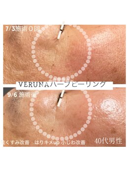 ココ 2号店(CoCo)/ハーブピーリング/肌質改善