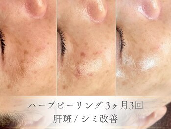 ベルペール(Belle perle)/【ハーブピーリング】毛穴/シミ