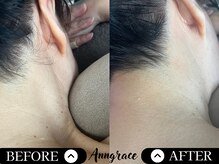 アングレイス(Anngrace)/ブライダル【お顔脱毛うなじ】