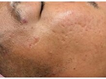 リベル 名古屋(Lebelle:)/ハーブピーリング　栄