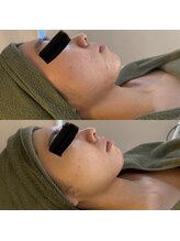 シーアイエステティック 船橋駅前店(c.iエステティック)/お顔のハーブピーリング♪