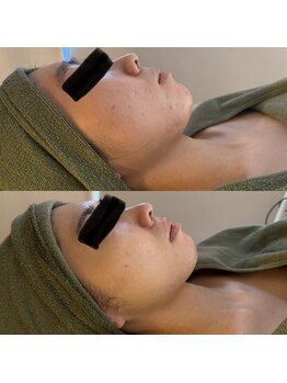 シーアイエステティック 船橋駅前店(c.iエステティック)/お顔のハーブピーリング♪