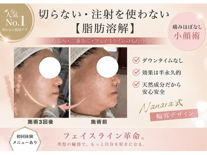 ナナラの写真