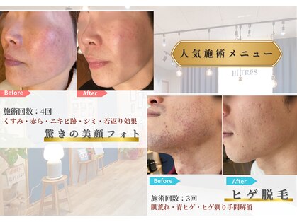 トレースの写真