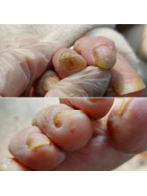 爪切り屋 足楽/N様 2022.8 ◆ゆびさきの角質