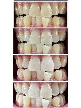 エクシアホワイトニング 日本橋店/４回（１ヶ月）