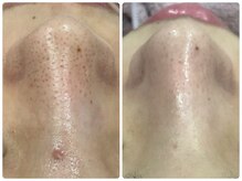 ベルネ(BELLUNE)/ベルネ式毛穴洗浄