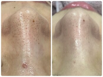 ベルネ(BELLUNE)/ベルネ式毛穴洗浄