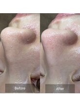 アネラ 難波(ANERA)/ハイドロスプラッシュ毛穴洗浄☆