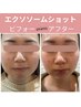 【速攻小顔】3種のエクソソーム導入！顔・首・肩・背中にも49900円→44000円