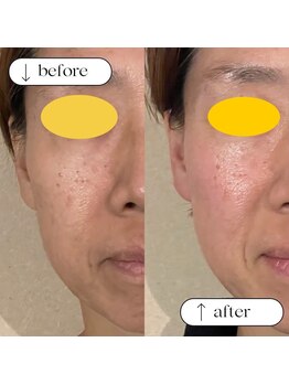 キラン 神戸店(Kiran)/一度の施術で結果がでる小顔矯正