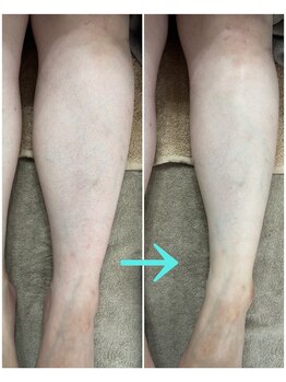 エタンセル(Etincelle)/脚スッキリコース