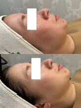 パリスヒロトン(PARIS HIROTON)/オプティル白玉 １回