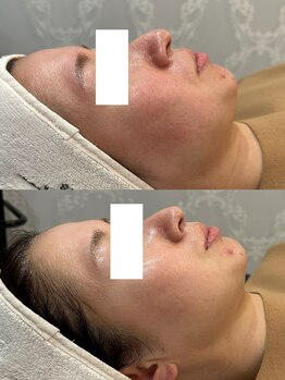 パリスヒロトン(PARIS HIROTON)/オプティル白玉 １回